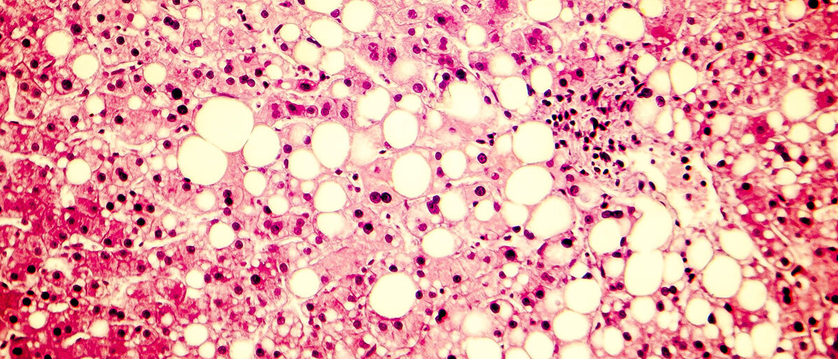 Mikroskopische Aufnahme von Leberzellen: Rote Leberzellen mit schwarzem Zellkern, dazwischen große gelbe Vakuolen mit Triglyceriden